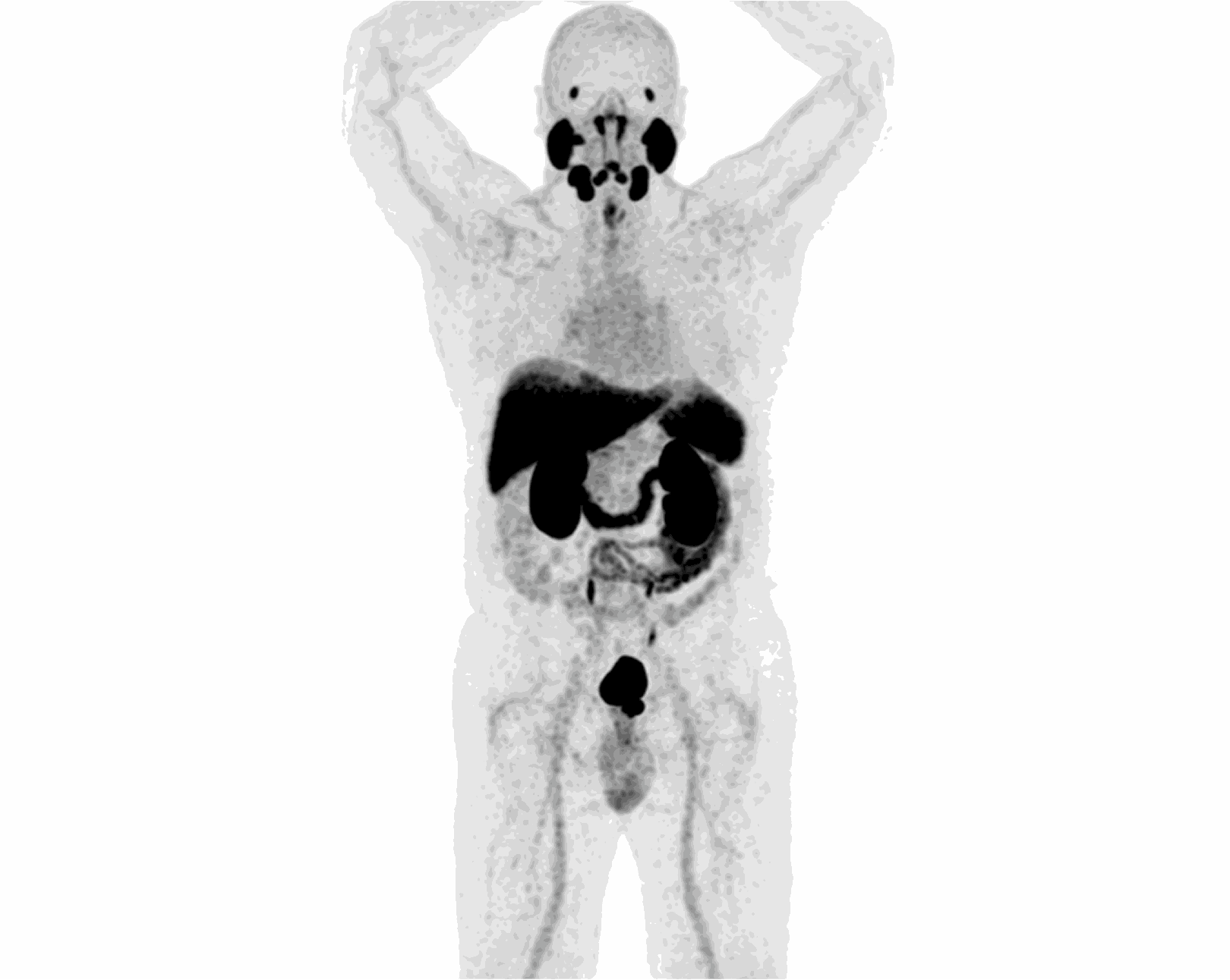 MIP scan — Scenario 1 Patient A